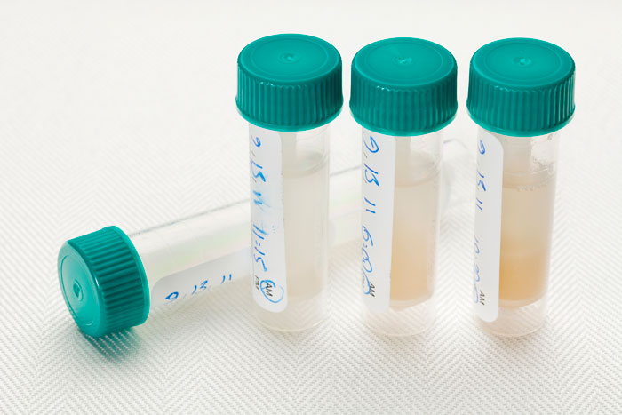 saliva samples from home breast cancer DNA test